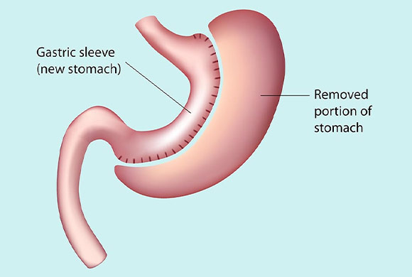 Sleeve Gastric Surgery