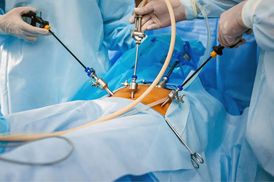 Mini Gastric Bypass Surgery